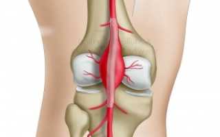 Что такое аневризма бедренной и подколенной артерии, чем опасна?