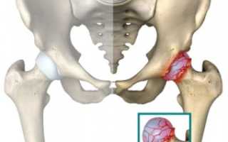 Как лечить артроз тазобедренного сустава – методики и средства