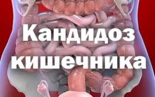 Кандидоз кишечника