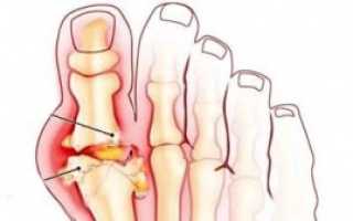 Причины, симптомы и лечение подагрического артрита