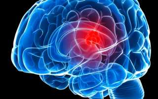 Из-за чего образуется менингиома головного мозга, чем опасно образование