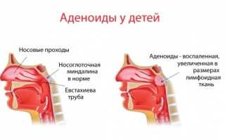 Температура при аденоидах у детей: причины, особенности, методы устранения проблемы