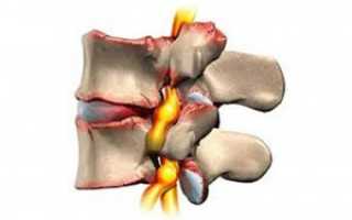 Признаки и лечение спондилоартроза пояснично-крестцового отдела позвоночника