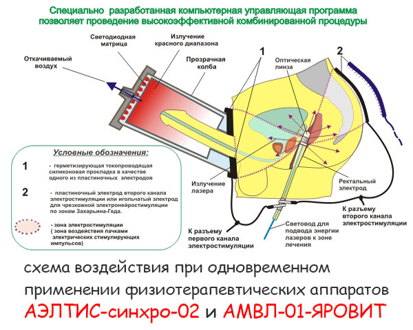 схема электростимулирования железы
