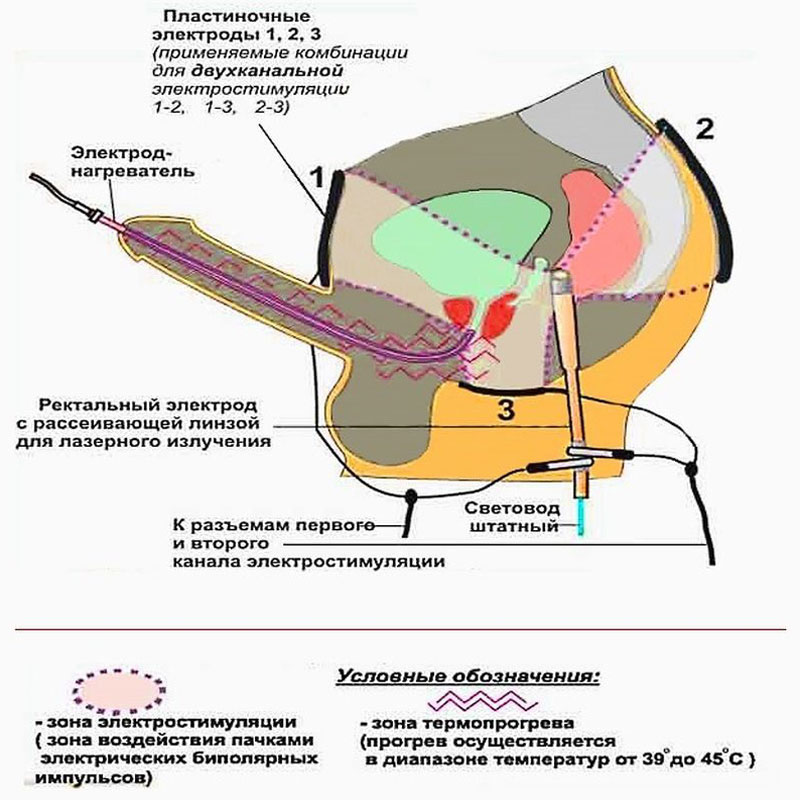схема наложения электродов и выполнения электростимуляции при болезнях простаты