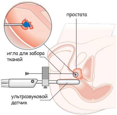 биопсия железы